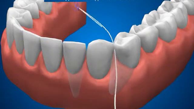Гигиена полости рта Гигиена промывного пространства под мостовидным протезом смотреть онлайн