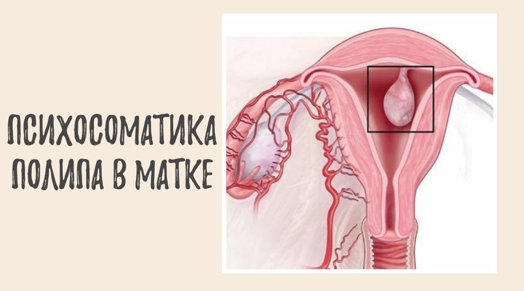 Психосоматика полипа в матке – полипы в матке и их настоящие причины.