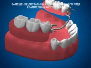 Бюгельный протез на кламмерах - нижняя челюсть