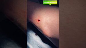 Удаление жирового образования (липомы)