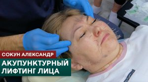 Акупунктурный лифтинг лица. Техники иглоукалывания для омоложения. Сокун Александр