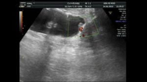 Канцероматоз брюшины . Рецидив рака яичника.