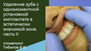 Удаление зуба и кисты с одномоментной установкой имплантата  в эстетически важной зоне. Часть 2.