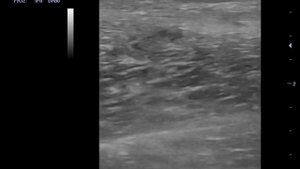 Частичный разрыв латеральной широкой мышцы бедра