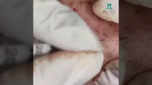 Relax squeezing out blackheads #2 Смачные Черные точки #2