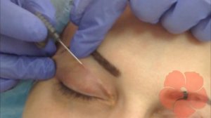 ПОСЛЕ БЛЕФАРОПЛАСТИКИ