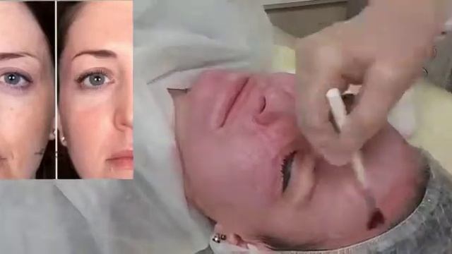 Обновление кожи с применением ТСА пилинга.