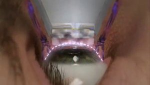 FEMTO LASIK Глазная хирургия Расческов Казань