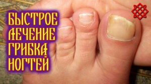 Лечение грибка ногтей на ногах. Как быстро вылечить грибок ногтей.mp4
