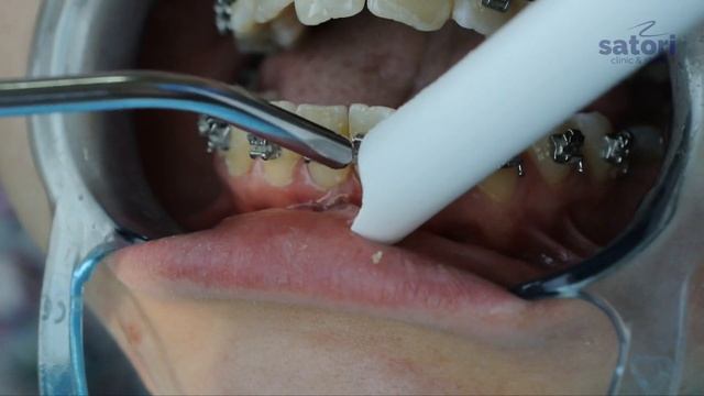Как заменить дуги в самолигирующих брекетах. Брекеты Самара влог,  braces update
