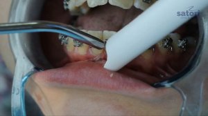 Как заменить дуги в самолигирующих брекетах. Брекеты Самара влог,  braces update