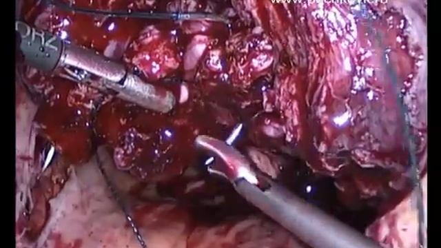 Лапароскопическая миомэктомия с временной окклюзией артериального русла