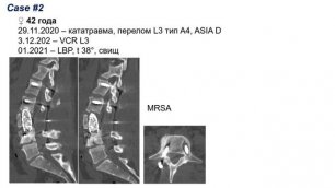 Семинар AO Spine – Осложнения при комплексных операциях на позвоночнике (часть 1).mp4