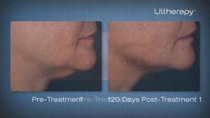 Ulthera® by Wave Plastic Surgery & Aesthetic Laser Center