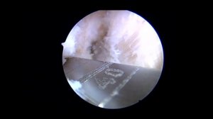 Артроскопия   Реконструкция ПКС .