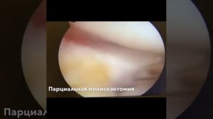 Разрыв латерального мениска. Клинический случай
