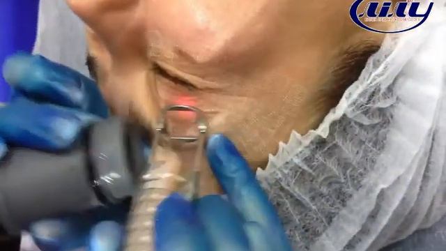 Фракционное омоложение в Кременчуге.Салон Лилу смотреть онлайн