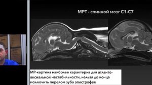 Атланто-аксиальная нестабильность у собаки