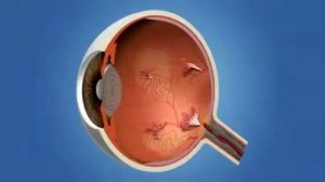 Диабетическая ретинопатия