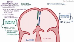 Дефект межпредсердной перегородки: что такое, механизм развития, симптомы и осложнения - кратко