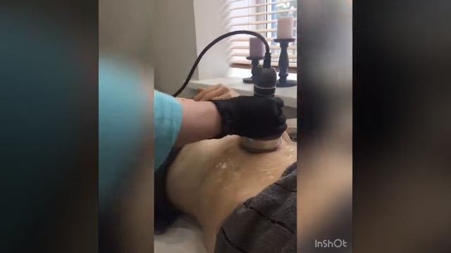 RF-лифтинг?
