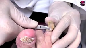 Pedicure Hoof Trimming // Обрезка Шлифовка Толстых Ногтей