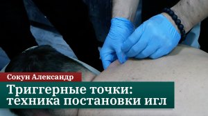 Триггерные точки в трапециевидных мышцах. Техника постановки игл. Сокун Александр