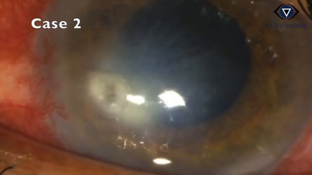 Cyanoacrylate Glue Application смотреть онлайн