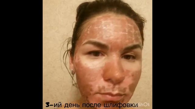 Проект «Преображение» 4 серия. Лазерная шлифовка лица. смотреть онлайн