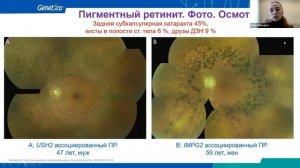 Пигментный ретинит: диагностика