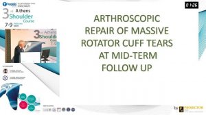 Massive cuff tears. The challenge of repair - Emmanouil Antonogiannakis