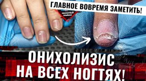 ?Жесткий Онихолизис Ногтей на руках ВСЕХ пальцев! Ожог ногтевой пластины,боковой онихолизис. Часть