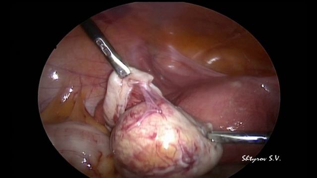Лапароскопия. Кистэктомия при зрелой тератоме. Бескровная техника. Оперирует Штыров С.В. смотреть онлайн
