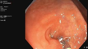 Круглый червь (острица) в толстой кишке. Колоноскопия, энтеробиоз, гельминтоз.