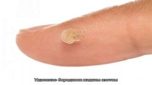 Почему появляются бородавки у детей? Причины появления и лечение бородавок. Фото