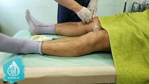 Хиджама при артрозе