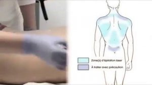 Epilium  Лазерная эпиляция спины и груди у мужчин