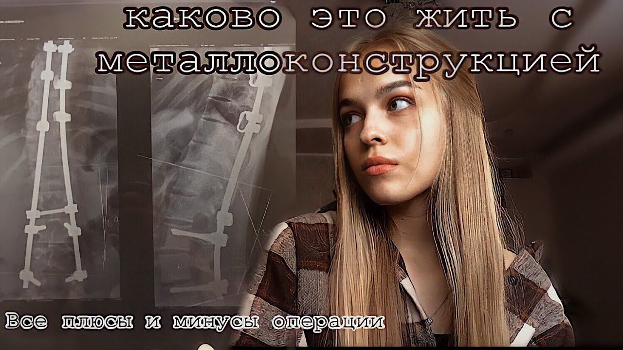ОГРАНИЧЕНИЯ после ОПЕРАЦИИ на сколиоз 4 степени/жизнь после операции на сколиоз
