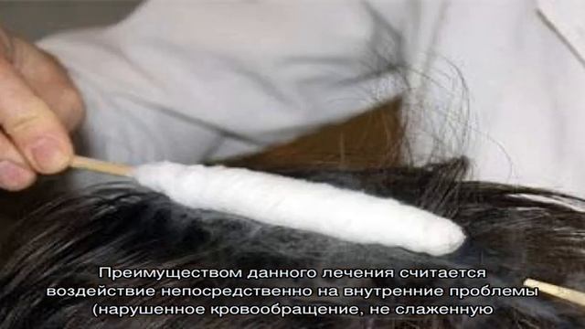 Эффективность лечебного криомассажа волосистой части головы