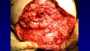 OSSEOINTEGRATION IN TRANSFEMORAL AMPUTEES. SURGICAL ASPECTS AND CASE REPORTS