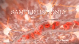 Инсульт: ишемический и геморрагический. Как отличить?