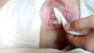 Обработка пролежней 3-4 степени после некроза .Глубокая рана.