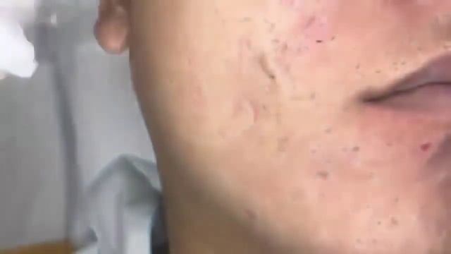прыщи давить новое видео  залипательные