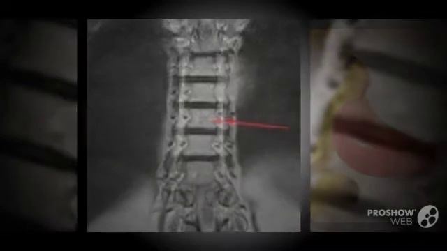 Что такое гемангиома в позвоночнике гемангиома что это