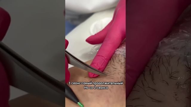 Хотим развеять миф о том что электроэпиляция это больно смотреть онлайн