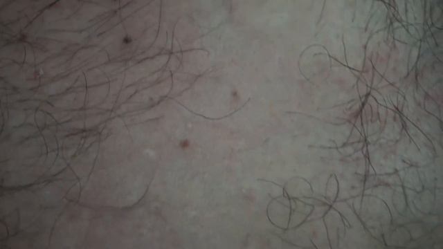 Лазерное Удаление Ангиомы На Груди и Спине смотреть онлайн