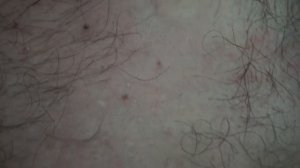 Лазерное Удаление Ангиомы На Груди и Спине