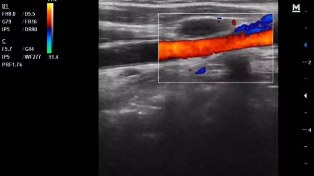 Процесс в области трахеи и лимфоузлы смотреть онлайн