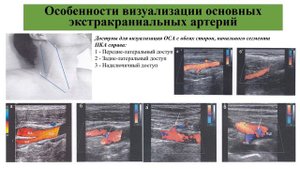 Павленко Анастасия Анатольевна "УЗИ брахиоцефальных артерий" (16.02.2024)
