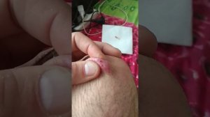 Что с моей ногой, самый большой прыщ или свищ,что это ,